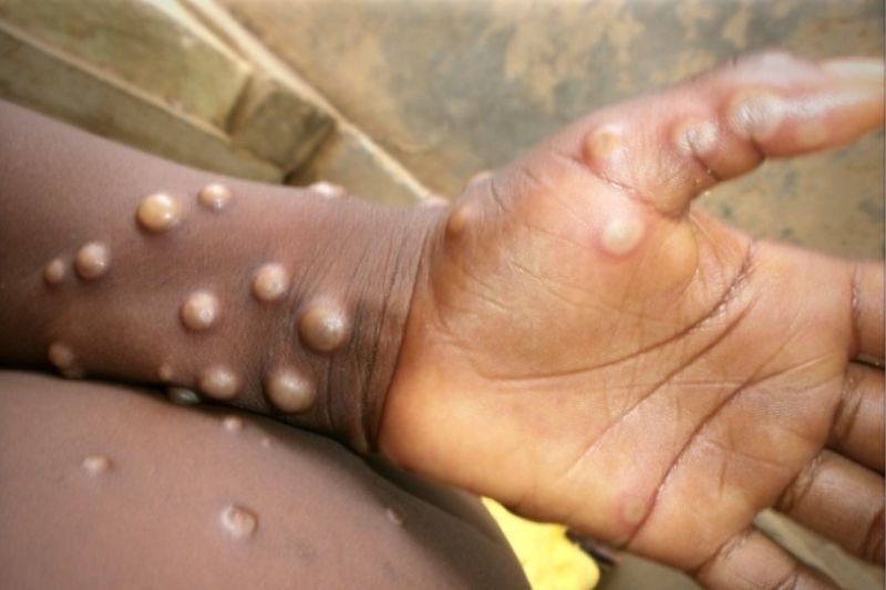 Brasil contabiliza 1,5 mil casos de mpox em 2024