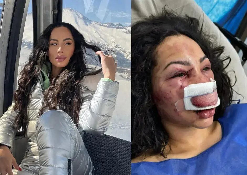 Turista brasileira é brutalmente espancada durante assalto no Chile