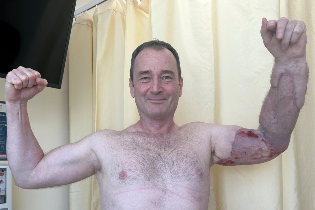 Homem quase perde o braço por bactéria após se machucar durante treino em academia