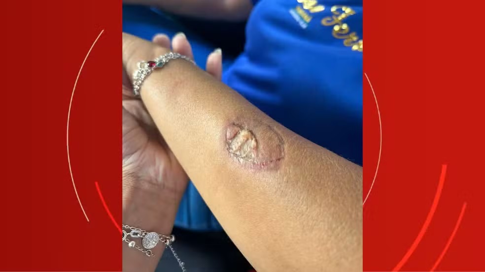 Discussão que acabou com vice-diretora sem pedaço da pele após ser mordida por mãe de aluno no PR