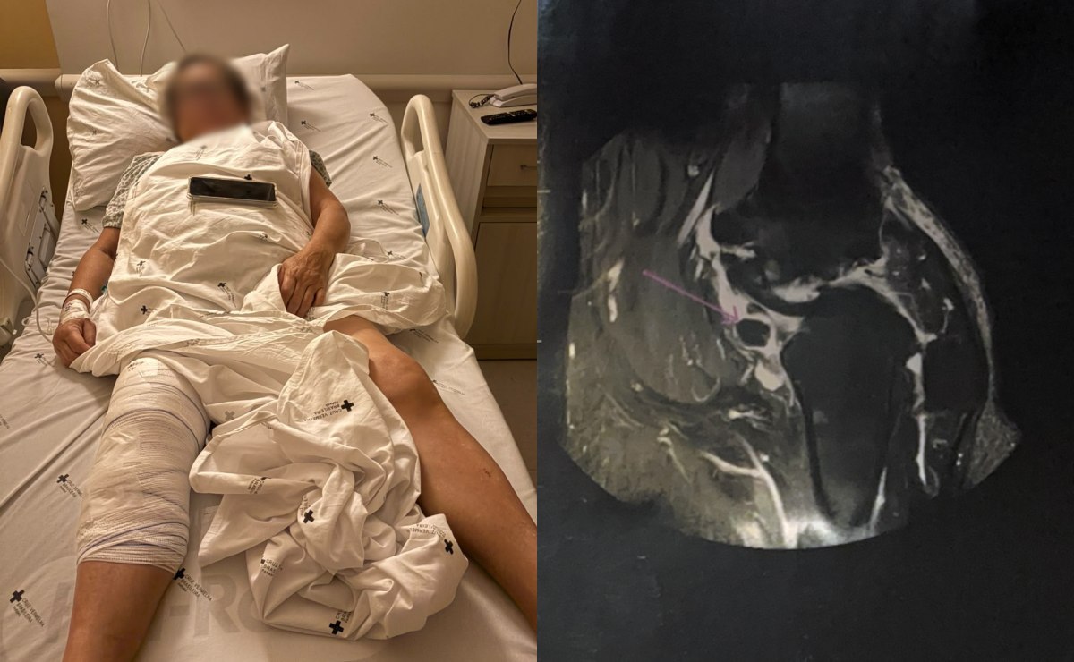 Idosa descobre após cirurgia que prótese foi colocada no joelho errado em Curitiba